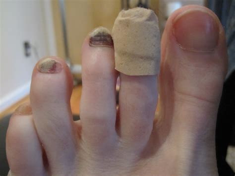 Blisters Black Toenails And Runners Feet The Bad And The Ugly There