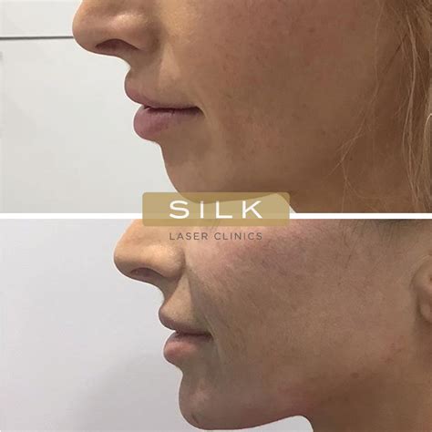 Jawline Filler Everything You Need To Know Silk Laser Clinics