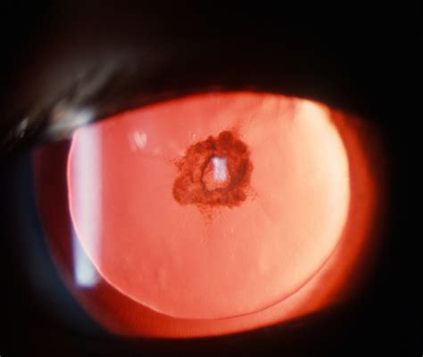 Figure Posterior Subcapsular Cataract Seen After StatPearls