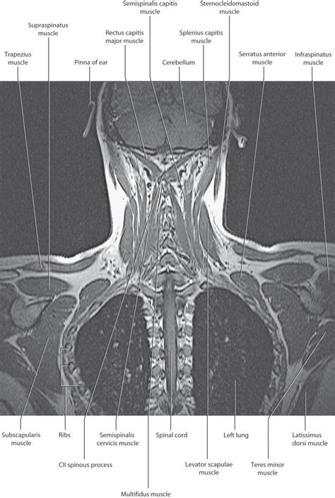 Posterior Triangle Of The Neck And Deep Neck Basicmedical Key