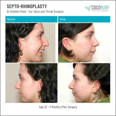 Septoplasty Before And After Photos Dr Stephen Kleid Fracs
