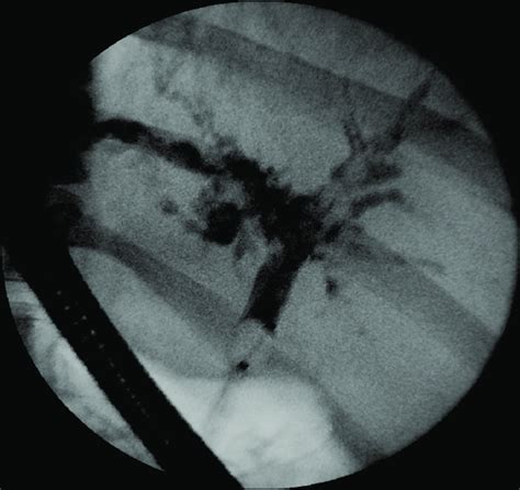 Cholangiogram Taken During Endoscopic Retrograde Download