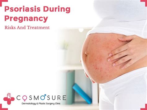 Psoriasis During Pregnancy Risks And Treatment Cosmosure Clinic