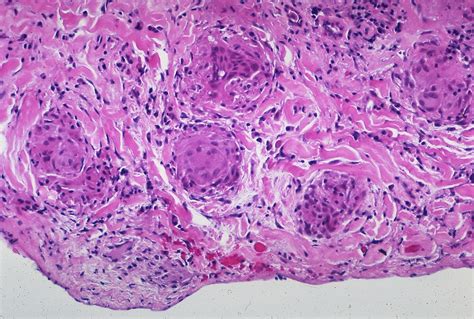 Sarcoidosis Pleural Granulomas Granulomatous Involvement Flickr