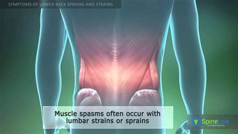 Lower Back Sprain And Strain Symptoms Youtube