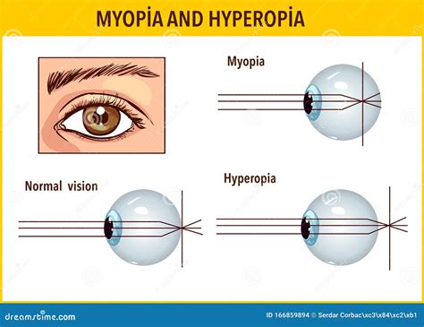 Optical Human Eye Defects Myopia And Hyperopia Stock Vector Illustration Of Normal Eyes