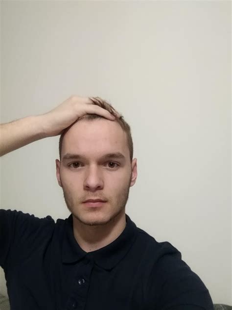 18 years old and balding without a doubt do i have a head type for going full bald i might