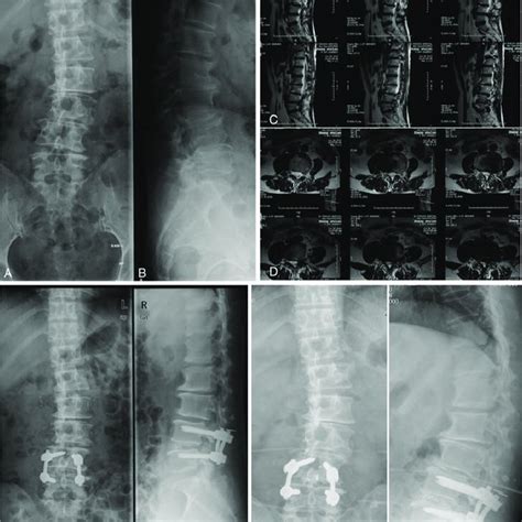 A 55 Year Old Female Patient Suffered From Adult Lumbar Degenerative