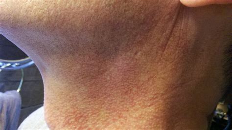 I Have A Splotchy Red Rash On Both Sides Of My Neck My Dermatologist