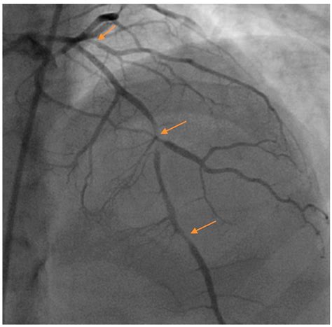 Jcm Free Full Text Update In Spontaneous Coronary Artery Dissection
