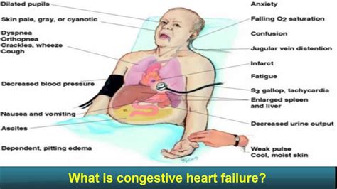 Congestive Heart Failure Congestive Heart Failure Explained Made