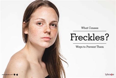 What Causes Freckles Ways To Prevent Them By Dr Himanshu Singhal Lybrate