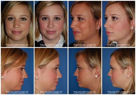 Crooked Nasal Bones Before And After Photo Gallery Nose Surgery Photos