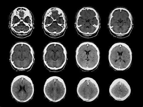 Ct Scan Brain Anatomy Anatomy Of Head Ct Scan Normal The Brain On Ct