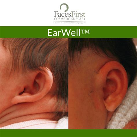 Earwell Infant Ear Correction Denver