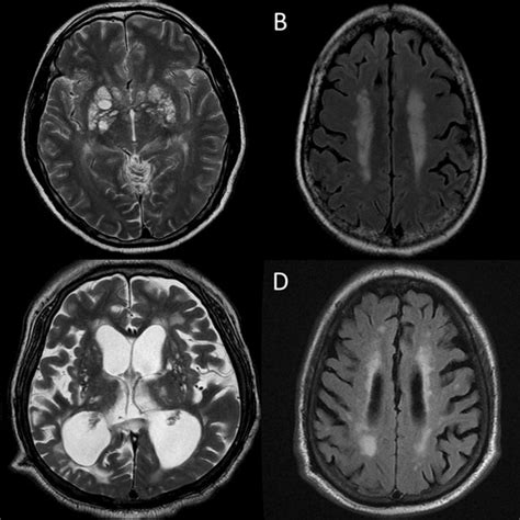 Examples Of The Brain Mri Findings Associated With Cryptococcus