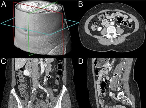 Nephrographic Phase Contrast Enhanced Abdominopelvic Ct In Axial B