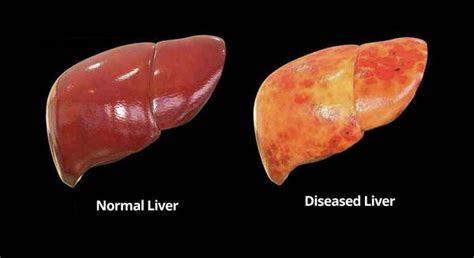 Stages Of Hepatic Steatosis