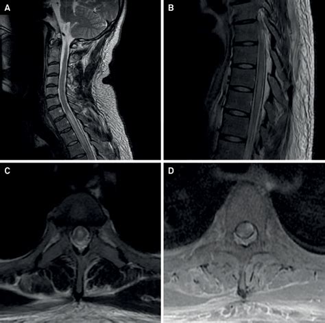 MRI Of The Vertebral Column Of A Patient With Transverse Myelitis