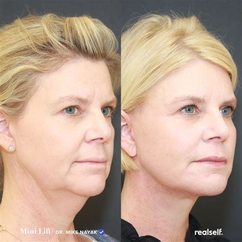 Mini Facelift Vs Full Facelift Whats The Difference Sagging Skin