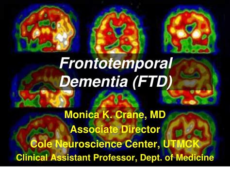 Ppt Frontotemporal Dementia Ftd Powerpoint Presentation Free