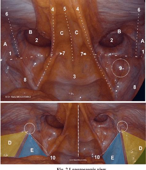 Laparoscopic Transabdominal Preperitoneal Inguinal Hernia Repair The