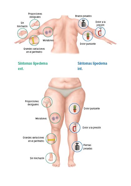 S Ntomas Y Tratamiento Del Lipedema Vivir Con Lipedema