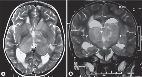 Figure 1 From Bilateral Thalamic Lesions In A Child Semantic Scholar