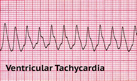 Pulseless Ventricular Tachycardia The First Aid Show