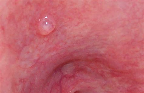 Oral Mucocele Causes Symptoms Diagnosis And Treatment