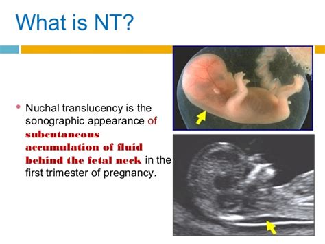 Nuchal translucency (nt) increased nuchal translucency first trimester test / double marker test : Mush mengOmel..: 1st checkup @ 7 minggu