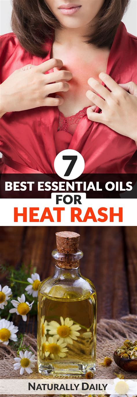 Heat Rash Treat Them Fast And Naturally Heat Rash Essential Oils
