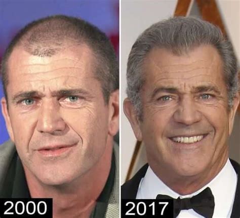 Bald Hollywood 5 Actors That Have Had Hair Transplants