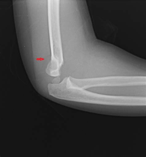 Figure Posterior Fat Pad Sign Supracondylar Fracture Contributed By