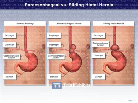 Paraesophageal Vs Sliding Hiatal Hernia Trial Exhibits Inc