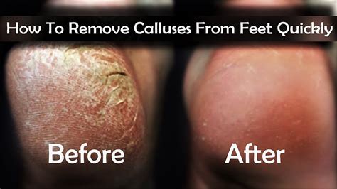 How To Remove Calluses From Feet 4 Easy Ways To Remove Calluses On Feet Quickly Youtube