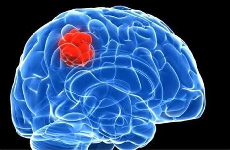 Glioblastoma Brain Cancer An Incurable Cancer Headstuff
