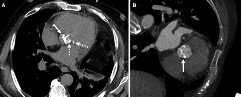 Aortic Valve Calcifications A Non Contrast Abdominal Ct Performed For