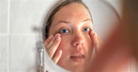 Bulging Eyes Causes Diagnosis And Treatments