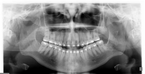 Thrill Of The Perfect Grill A Braces And Jaw Surgery Diary New Xrays