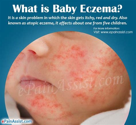 What Is Baby Eczemacausessymptomstreatmenthome Remedies