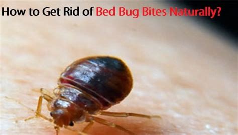 How To Get Rid Of Bed Bug Bites Naturally