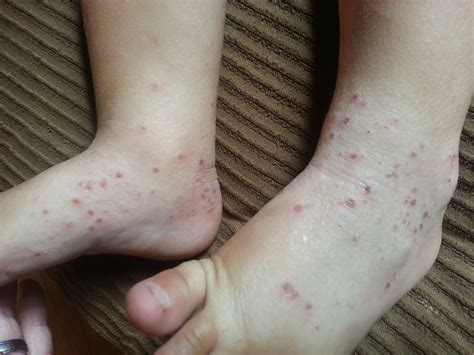 Atopic Dermatitis Eczema How To Control It