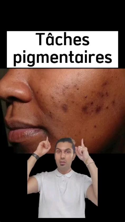 Comment Se D Barrasser De T Ches Pigmentaires Micro Kystes Et