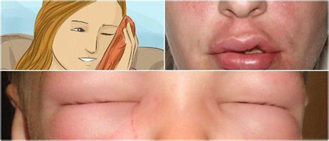 Face Swelling Causes Symptoms Diagnosis And Treatment Hoool