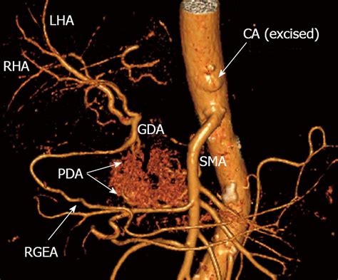 Liver Blood Supply After A Modified Appleby Procedure In Classical And