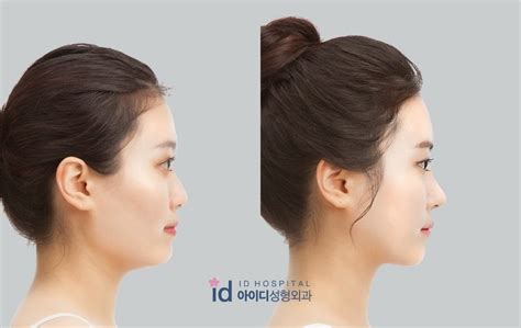 Id Hospital Korea Plastic Surgery Id Hospital Korea Our Patients Top