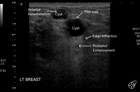 Ultrasound Image Of Multiple Cysts In The Left Breast O Open I