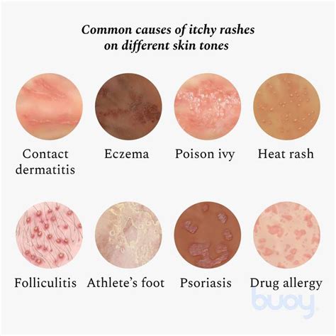 How To Tell Whether That Itchy Rash Is Eczema Or Psoriasis Hk Dermatology Dermatology Clinic