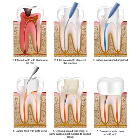 We did not find results for: Root Canal Treatment in Purley at Confidental Clinic